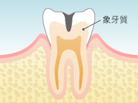 虫歯の進行 Level 3:C2