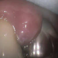 咬む面の溝のむし歯1