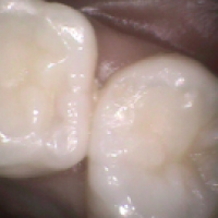 歯と歯の間のむし歯1