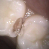 歯と歯の間のむし歯3