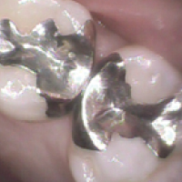 歯と歯の間のむし歯4