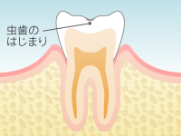 虫歯の進行 Level 1:C0
