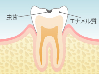虫歯の進行 Level 2:C1