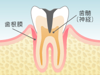 虫歯の進行 Level 4:C3