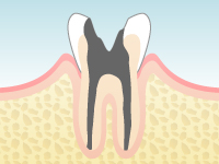 虫歯の進行 Level 5:C4
