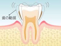 Level 4: 重度歯周炎