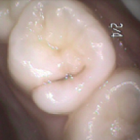 咬む面の溝のむし歯1