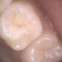 咬む面の溝のむし歯2