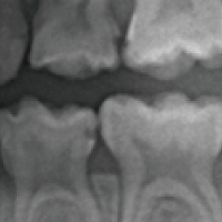 歯と歯の間のむし歯2